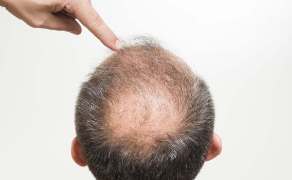 脂溢性脱发怎么治疗 推荐8个应对小窍门