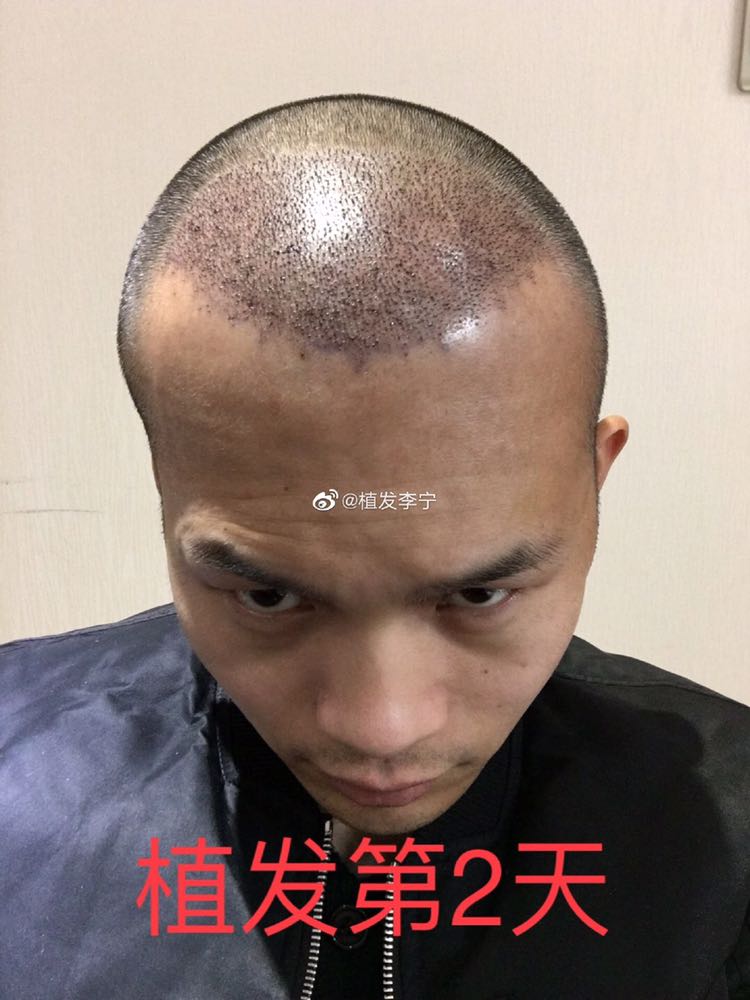 发际线_稀少加密_美人尖怎么样_术后第2年效果图_植发