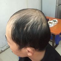 禿頂用戶圖片