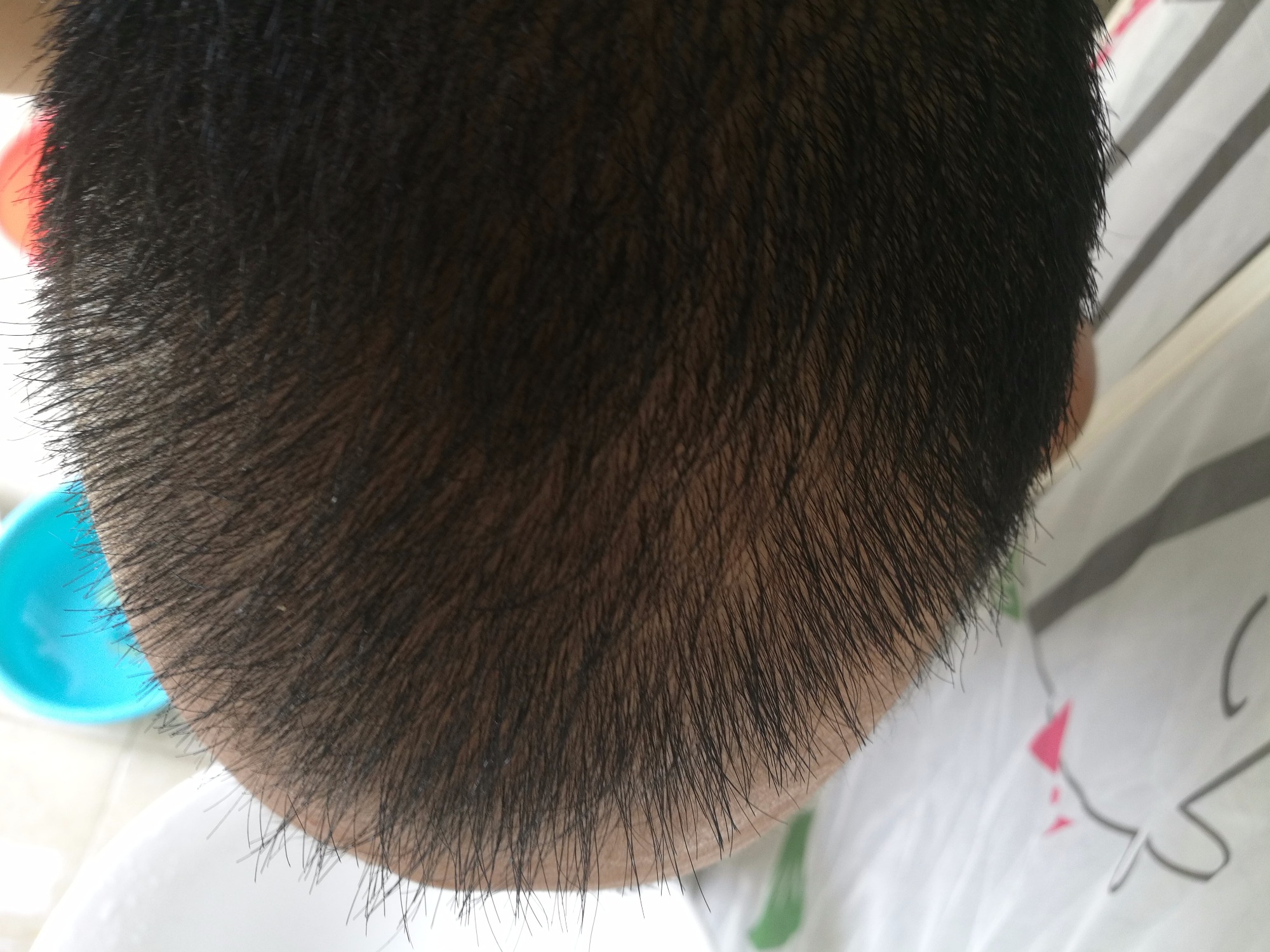 新种植的头发长势越来越密集,三个月的效果