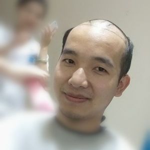 秃头油腻大叔现植发归来帅回原来样子