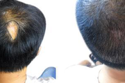 疤痕毛发种植的原理是什么?疤痕移植毛发价格