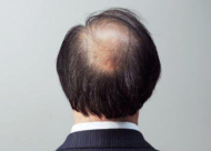 你从脱发到秃顶用了多久？你有注意这个过程吗？