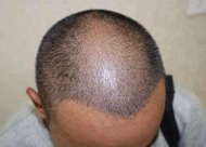  植发后需要多长时间恢复？人工植发能保持多久？
