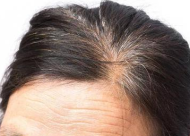 前额头发少怎么办 前额头发少的原因是什么？