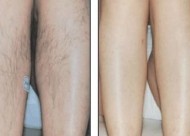 腿毛种植的原理是什么？腿毛移植的效果怎么样？