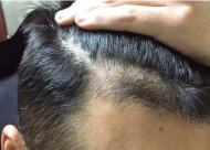 哪些头部疤痕适合做植发 术后多久能见效果