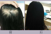 【稀疏加密】头发加密安全吗 头发加密多久见效