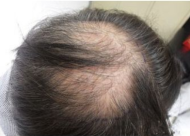 秃顶遗传吗？防治脱发秃顶的方法有哪些？