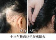 【疤痕植发】 瘢痕性脱发能治好 疤痕植发效果好吗