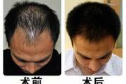 植发后效果不自然的表现 如何保证植发的自然度