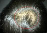 头发加密技术怎么样？头发加密会不会损害其它毛囊？