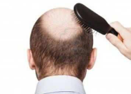 男性脱发的九大主要原因 你踩了其中几点？