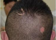 哪些情况可以疤痕植发？疤痕植发禁忌人群有哪些？