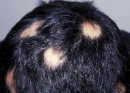 毛发疾病有哪些 毛发常见病的原因是什么