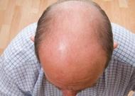 【秃顶植发】盘点|秃顶植发术后十大注意事项