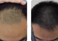 男性植发有副作用吗 男性植发后会有疤痕吗