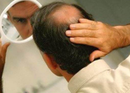 秃顶的症状表现是什么 秃顶怎么治疗