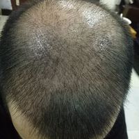 禿頂用戶圖片