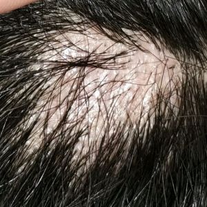 疤痕植发分享社区