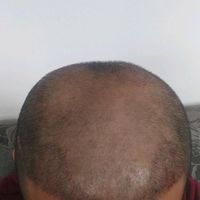 禿頂用戶圖片
