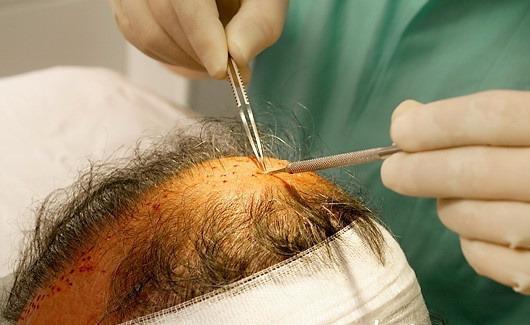 头发移植是通过特殊器械将头发毛囊周围部分组织一并完整切取,脱离
