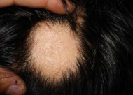 疤痕种植条件有哪些 植发手术费用是多少