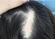 疤痕毛发移植怎么样 疤痕植发术后注意内容