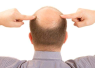 病理性脱发还能再生吗 如何判断自己是病理性脱发