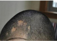 疤痕植发与一般植发有区别吗 哪种情况能进行疤痕种植