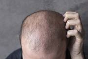 肾虚脱发有哪些症状 肾虚型脱发怎么治疗