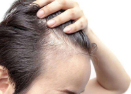 疤痕性脱发与化学性脱发区别 疤痕植发术前注意事项