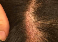如何保障疤痕植发效果 疤痕种植技术有哪些