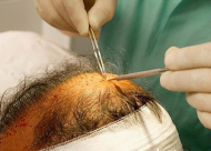 毛发移植会伤害到原生发吗 会呈现哪些并发症