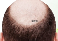 OM型脱发有哪些治疗方法 O型脱发形成原因