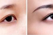 眉毛种植后3个月才能长出毛发吗 植眉有哪些特点