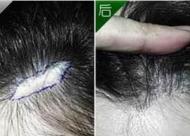 头部有三厘米的疤痕对植发有影响吗 疤痕种植的***高吗