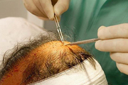哪些人群不适合进行做植发 这五类人群不能植发