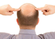 自体毛发移植术靠谱吗 毛发种植技术有哪些