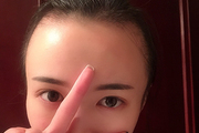 发际线过高或过低怎么办 发际线调整能解决吗
