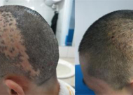 疤痕种植真的能去除头部疤痕吗 疤痕植发价格多少钱