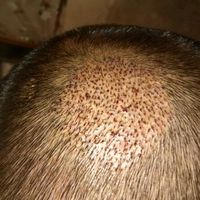 疤痕植發(fā)用戶圖片
