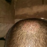 疤痕植發(fā)用戶圖片