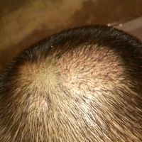 疤痕植發(fā)用戶圖片