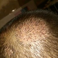 疤痕植發(fā)用戶圖片