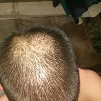 疤痕植發(fā)用戶圖片