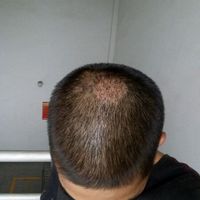 疤痕植發(fā)用戶圖片
