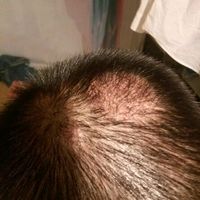 疤痕植發(fā)用戶圖片