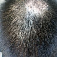 疤痕植發(fā)用戶圖片