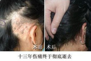 疤痕植发的成功率高吗 哪些病例适合疤痕种植
